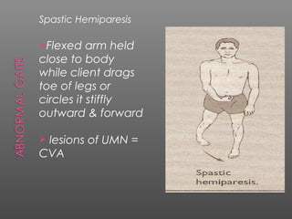 Spastic Hemiparesis

Flexed    arm held
close to body
while client drags
toe of legs or
circles it stiffly
outward & forward

lesions of UMN =
CVA
 