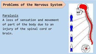 Paralysis
A loss of sensation and movement
of part of the body due to an
injury of the spinal cord or
brain.
Problems of the Nervous System
 