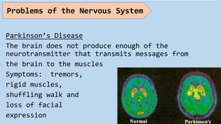Parkinson’s Disease
The brain does not produce enough of the
neurotransmitter that transmits messages from
the brain to the muscles
Symptoms: tremors,
rigid muscles,
shuffling walk and
loss of facial
expression
Problems of the Nervous System
 
