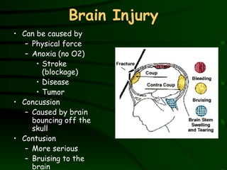 Brain Injury Can be caused by Physical force Anoxia (no O2) Stroke (blockage) Disease  Tumor Concussion  Caused by brain bouncing off the skull Contusion More serious Bruising to the brain 