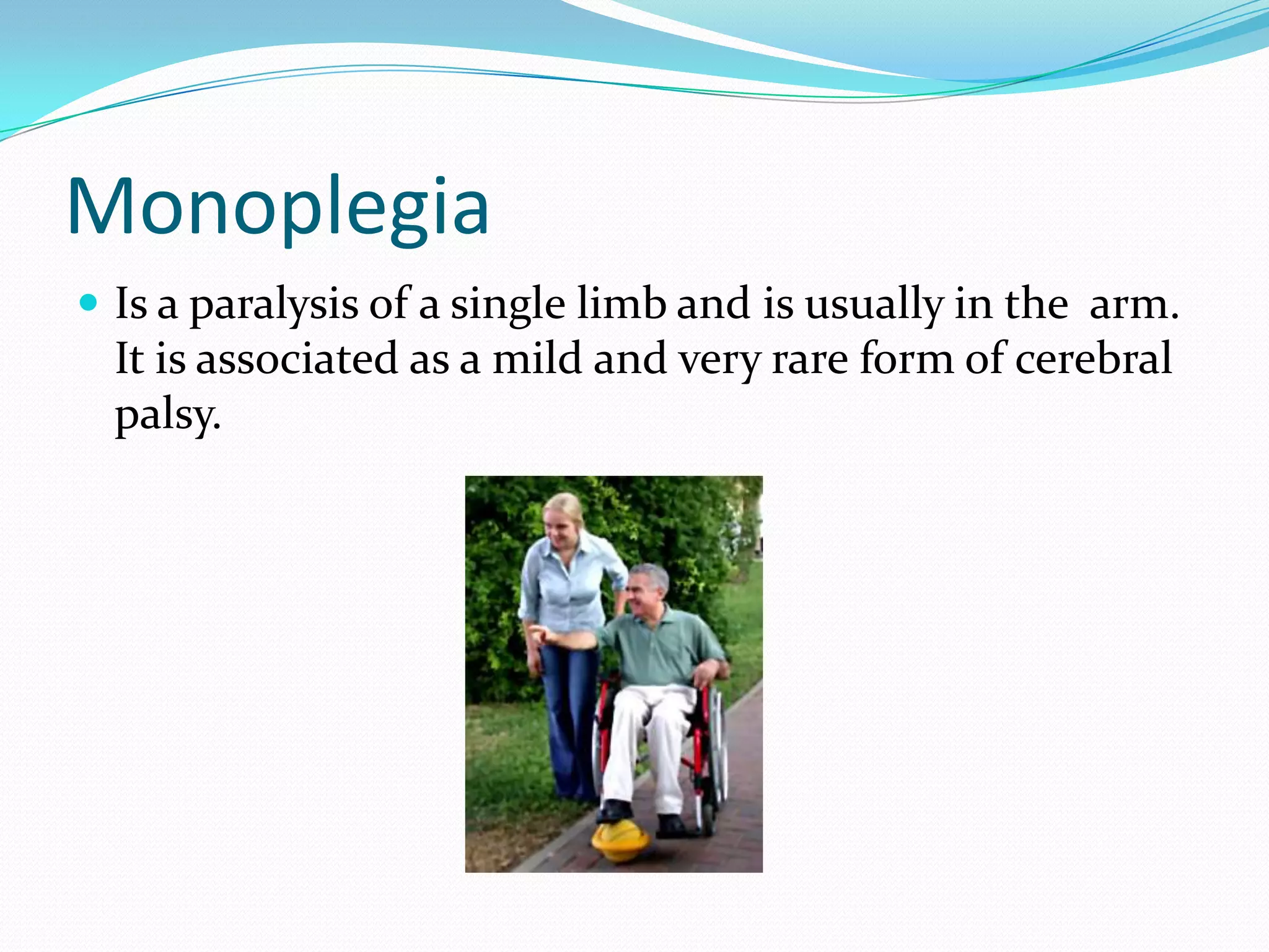 MonoplegiaIs a paralysis of a single limb and is usually in the arm. It is associated as a mild and very rare form of cerebral palsy.