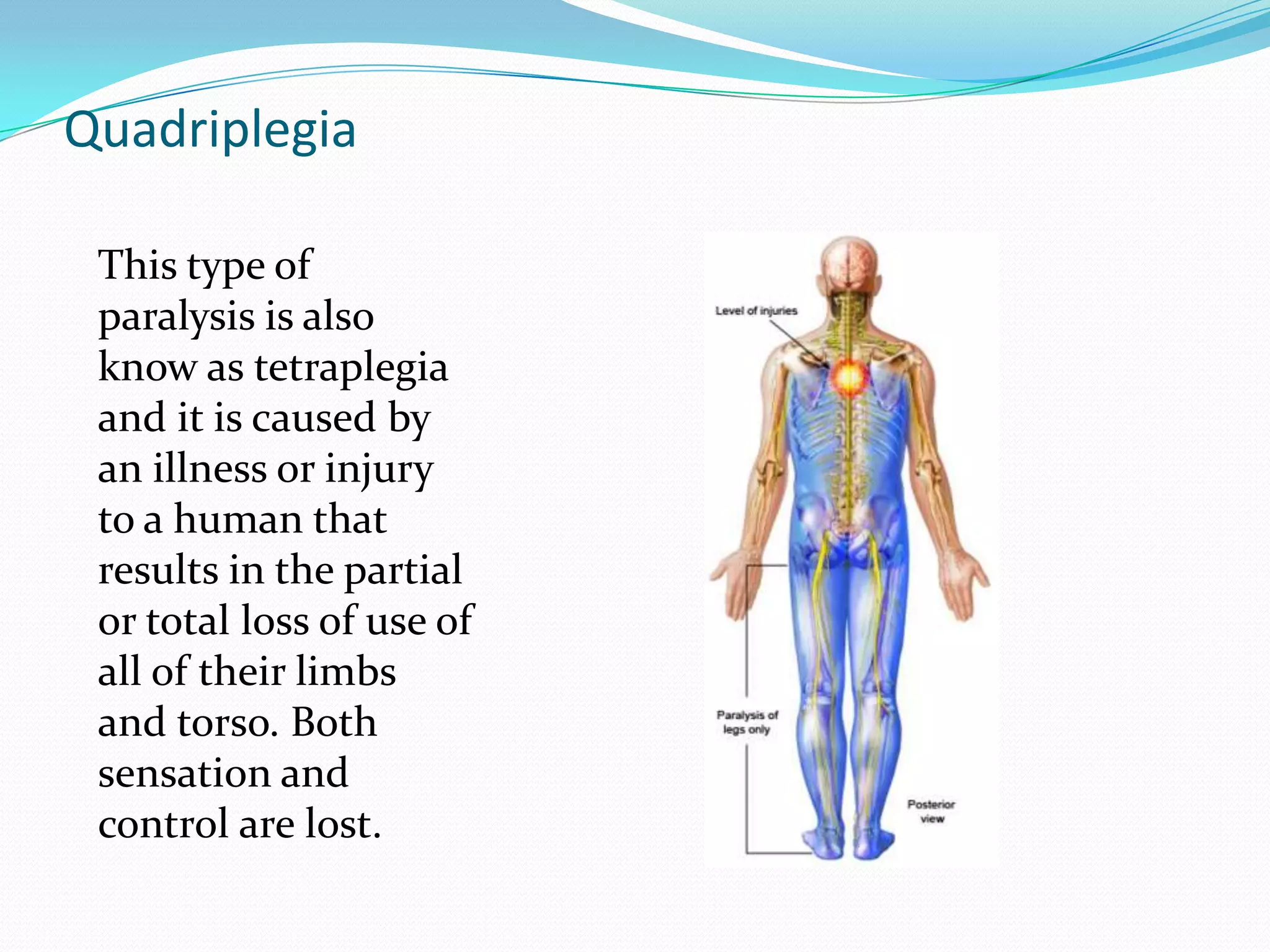 QuadriplegiaThis type of paralysis is also know as tetraplegiaand it is caused by an illness or injury to a human that results in the partial or total loss of use of all of their limbs and torso. Both sensation and control are lost.