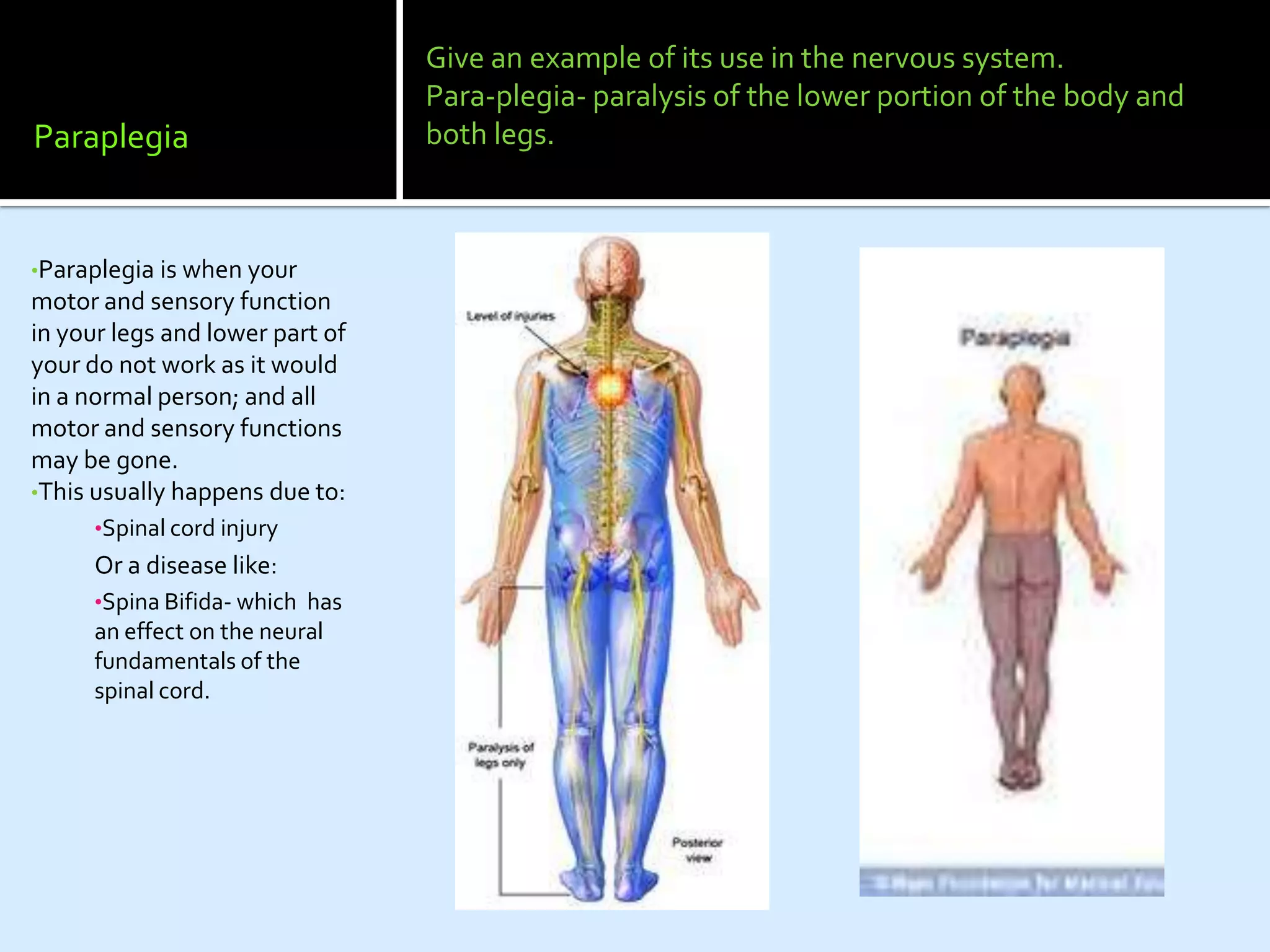 Give an example of its use in the nervous system.
                                 Para-plegia- paralysis of the lower portion of the body and
Paraplegia                       both legs.



•Paraplegia is when your
motor and sensory function
in your legs and lower part of
your do not work as it would
in a normal person; and all
motor and sensory functions
may be gone.
•This usually happens due to:
      •Spinal cord injury
      Or a disease like:
      •Spina Bifida- which has
      an effect on the neural
      fundamentals of the
      spinal cord.
 