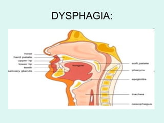 DYSPHAGIA: