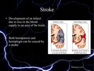 Stroke
●

●

Development of an infarct
due to loss in the blood
supply to an area of the brain.

Both hemiparesis and
hemiplegia can be caused by
a stroke

Strokedoctor.com

 