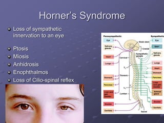 Horner’s Syndrome
Loss of sympathetic
innervation to an eye
Ptosis
Miosis
Anhidrosis
Enophthalmos
Loss of Cilio-spinal reflex
 