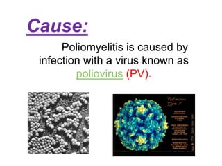 Cause:Poliomyelitis is caused by infection with a virus known as poliovirus (PV).