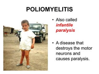 POLIOMYELITIS,[object Object],Also called infantile paralysis,[object Object],A disease that destroys the motor neurons and causes paralysis.,[object Object]
