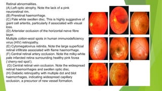 Retinal abnormalities.
(A) Left optic atrophy. Note the lack of a pink
neuroretinal rim.
(B) Preretinal haemorrhage.
(C) Pale white swollen disc. This is highly suggestive of
giant cell arteritis, particularly if associated with visual
loss.
(D) Arteriolar occlusion of the horizontal nerve fibre
layer.
Multiple cotton-wool spots in human immunodeficiency
virus (HIV) retinopathy.
(E) Cytomegalovirus retinitis. Note the large superficial
retinal infiltrate associated with flame haemorrhage.
(F) Central retinal artery occlusion. Note the milky-white
pale infarcted retina surrounding healthy pink fovea
(‘cherry-red spot’).
(G) Central retinal vein occlusion. Note the widespread
retinal haemorrhages and swollen optic disc.
(H) Diabetic retinopathy with multiple dot and blot
haemorrhages, indicating widespread capillary
occlusion, a precursor of new vessel formation.
 