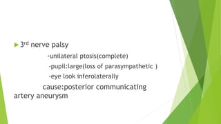  3rd nerve palsy
-unilateral ptosis(complete)
-pupil:large(loss of parasympathetic )
-eye look inferolaterally
cause:posterior communicating
artery aneurysm
 