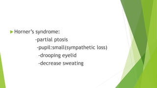  Horner’s syndrome:
-partial ptosis
-pupil:small(sympathetic loss)
-drooping eyelid
-decrease sweating
 