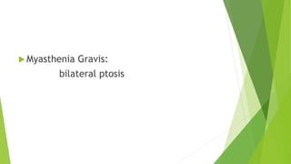  Myasthenia Gravis:
bilateral ptosis
 