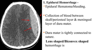 1. Epidural Hemorrhage -
Epidural Hematoma/bleeding.
 Collection of blood between
skull/periosteal layer & meningeal
layer of dura mater.
 Dura mater is tightly connected to
suture.
Lens shaped/Biconvex shaped
hemorrhage is
 