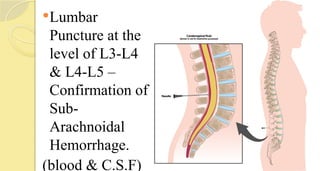 Lumbar
Puncture at the
level of L3-L4
& L4-L5 –
Confirmation of
Sub-
Arachnoidal
Hemorrhage.
(blood & C.S.F)
 
