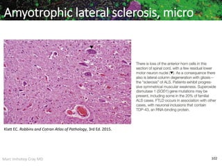 Marc Imhotep Cray MD 102
Amyotrophic lateral sclerosis, micro
Klatt EC. Robbins and Cotran Atlas of Pathology, 3rd Ed. 2015.
 