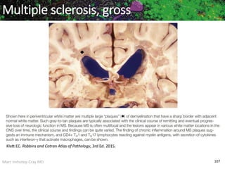 Marc Imhotep Cray MD 107
Multiple sclerosis, gross
Klatt EC. Robbins and Cotran Atlas of Pathology, 3rd Ed. 2015.
 