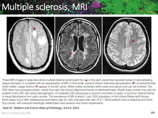 Marc Imhotep Cray MD 108
Multiple sclerosis, MRI
Klatt EC. Robbins and Cotran Atlas of Pathology, 3rd Ed. 2015.
 