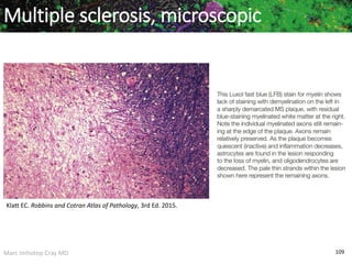 Marc Imhotep Cray MD 109
Multiple sclerosis, microscopic
Klatt EC. Robbins and Cotran Atlas of Pathology, 3rd Ed. 2015.
 