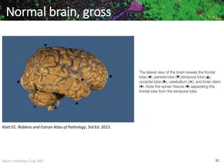 Marc Imhotep Cray MD 11
Normal brain, gross
Klatt EC. Robbins and Cotran Atlas of Pathology, 3rd Ed. 2015.
 