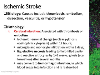 Marc Imhotep Cray MD
Ischemic Stroke
119
Etiology: Causes include thrombosis, embolism,
dissection, vasculitis, or hypotension
Pathology:
i. Cerebral infarction: Associated with thrombosis or
embolism
 Ischemic neuronal change (nuclear pyknosis,
eosinophilic cytoplasm) within 12 hours;
 microglia and monocyte infiltration within 2 days;
 liquefactive necrosis leading to fluid-filled cavity
and reactive astrocytes by 1–3 weeks; gliosis (scar
formation) after several months
 may convert to hemorrhagic infarction, in which
blood seeps into infarction and is reabsorbed
 