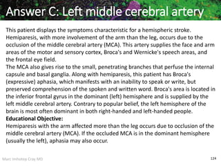 Marc Imhotep Cray MD 124
This patient displays the symptoms characteristic for a hemispheric stroke.
Hemiparesis, with more involvement of the arm than the leg, occurs due to the
occlusion of the middle cerebral artery (MCA). This artery supplies the face and arm
areas of the motor and sensory cortex, Broca's and Wernicke's speech areas, and
the frontal eye field.
The MCA also gives rise to the small, penetrating branches that perfuse the internal
capsule and basal ganglia. Along with hemiparesis, this patient has Broca's
(expressive) aphasia, which manifests with an inability to speak or write, but
preserved comprehension of the spoken and written word. Broca's area is located in
the inferior frontal gyrus in the dominant (left) hemisphere and is supplied by the
left middle cerebral artery. Contrary to popular belief, the left hemisphere of the
brain is most often dominant in both right-handed and left-handed people.
Educational Objective:
Hemiparesis with the arm affected more than the leg occurs due to occlusion of the
middle cerebral artery (MCA). If the occluded MCA is in the dominant hemisphere
(usually the left), aphasia may also occur.
Answer C: Left middle cerebral artery
 