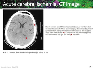 Marc Imhotep Cray MD 125
Acute cerebral ischemia, CT image
Klatt EC. Robbins and Cotran Atlas of Pathology, 3rd Ed. 2015.
 