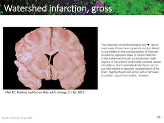 Marc Imhotep Cray MD 126
Watershed infarction, gross
Klatt EC. Robbins and Cotran Atlas of Pathology, 3rd Ed. 2015.
 