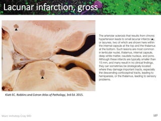 Marc Imhotep Cray MD 127
Lacunar infarction, gross
Klatt EC. Robbins and Cotran Atlas of Pathology, 3rd Ed. 2015.
 