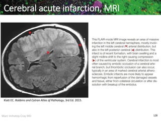 Marc Imhotep Cray MD 128
Cerebral acute infarction, MRI
Klatt EC. Robbins and Cotran Atlas of Pathology, 3rd Ed. 2015.
 