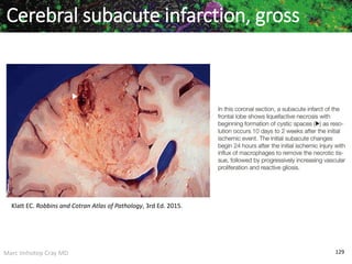 Marc Imhotep Cray MD 129
Cerebral subacute infarction, gross
Klatt EC. Robbins and Cotran Atlas of Pathology, 3rd Ed. 2015.
 
