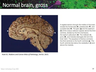Marc Imhotep Cray MD 13
Normal brain, gross
Klatt EC. Robbins and Cotran Atlas of Pathology, 3rd Ed. 2015.
 