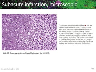Marc Imhotep Cray MD 130
Subacute infarction, microscopic
Klatt EC. Robbins and Cotran Atlas of Pathology, 3rd Ed. 2015.
 