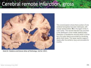 Marc Imhotep Cray MD 131
Cerebral remote infarction, gross
Klatt EC. Robbins and Cotran Atlas of Pathology, 3rd Ed. 2015.
 