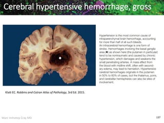 Marc Imhotep Cray MD 137
Cerebral hypertensive hemorrhage, gross
Klatt EC. Robbins and Cotran Atlas of Pathology, 3rd Ed. 2015.
 