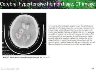 Marc Imhotep Cray MD 139
Cerebral hypertensive hemorrhage, CT image
Klatt EC. Robbins and Cotran Atlas of Pathology, 3rd Ed. 2015.
 