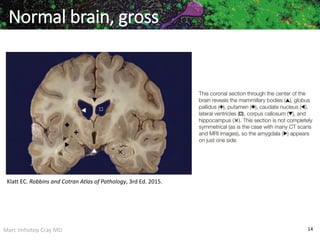 Marc Imhotep Cray MD 14
Normal brain, gross
Klatt EC. Robbins and Cotran Atlas of Pathology, 3rd Ed. 2015.
 