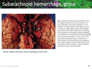 Marc Imhotep Cray MD 145
Subarachnoid hemorrhage, gross
Klatt EC. Robbins and Cotran Atlas of Pathology, 3rd Ed. 2015.
 