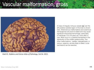 Marc Imhotep Cray MD 146
Vascular malformation, gross
Klatt EC. Robbins and Cotran Atlas of Pathology, 3rd Ed. 2015.
 