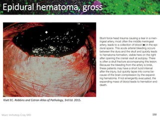 Marc Imhotep Cray MD 150
Epidural hematoma, gross
Klatt EC. Robbins and Cotran Atlas of Pathology, 3rd Ed. 2015.
 
