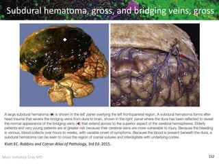 Marc Imhotep Cray MD 152
Subdural hematoma, gross, and bridging veins, gross
Klatt EC. Robbins and Cotran Atlas of Pathology, 3rd Ed. 2015.
 