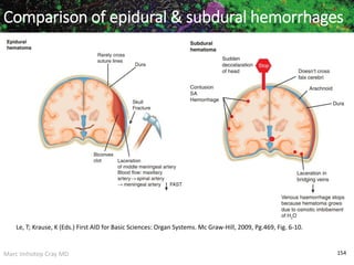 Marc Imhotep Cray MD 154
Comparison of epidural & subdural hemorrhages
Le, T; Krause, K (Eds.) First AID for Basic Sciences: Organ Systems. Mc Graw-Hill, 2009, Pg.469, Fig. 6-10.
 