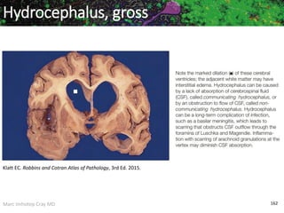 Marc Imhotep Cray MD 162
Hydrocephalus, gross
Klatt EC. Robbins and Cotran Atlas of Pathology, 3rd Ed. 2015.
 
