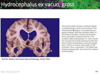 Marc Imhotep Cray MD 164
Hydrocephalus ex vacuo, gross
Klatt EC. Robbins and Cotran Atlas of Pathology, 3rd Ed. 2015.
 