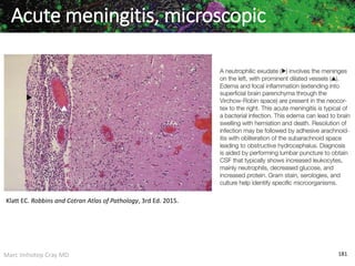 Marc Imhotep Cray MD 181
Acute meningitis, microscopic
Klatt EC. Robbins and Cotran Atlas of Pathology, 3rd Ed. 2015.
 