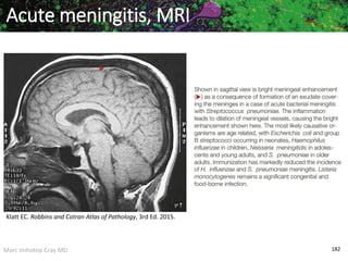 Marc Imhotep Cray MD 182
Acute meningitis, MRI
Klatt EC. Robbins and Cotran Atlas of Pathology, 3rd Ed. 2015.
 