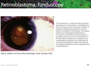 Marc Imhotep Cray MD 239
Retinoblastoma, funduscopy
Klatt EC. Robbins and Cotran Atlas of Pathology, 3rd Ed. Saunders, 2015.
 