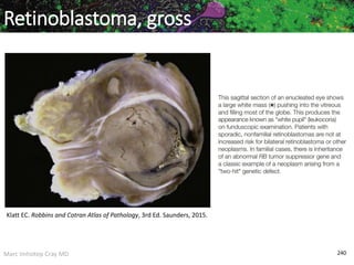 Marc Imhotep Cray MD 240
Retinoblastoma, gross
Klatt EC. Robbins and Cotran Atlas of Pathology, 3rd Ed. Saunders, 2015.
 