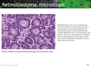 Marc Imhotep Cray MD 241
Retinoblastoma, microscopic
Klatt EC. Robbins and Cotran Atlas of Pathology, 3rd Ed. Saunders, 2015.
 