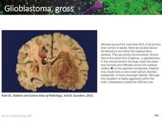 Marc Imhotep Cray MD 245
Glioblastoma, gross
Klatt EC. Robbins and Cotran Atlas of Pathology, 3rd Ed. Saunders, 2015.
 