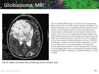 Marc Imhotep Cray MD 246
Glioblastoma, MRI
Klatt EC. Robbins and Cotran Atlas of Pathology, 3rd Ed. Saunders, 2015.
 
